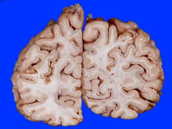 4B7 Infarct, Watershed (Case 4) 16