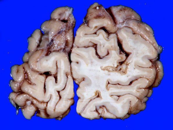 4B9 Infarct, Watershed (Case 4) 20