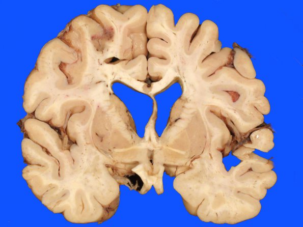 5A1 Infarct, watershed, recent (Case 5) gross 1