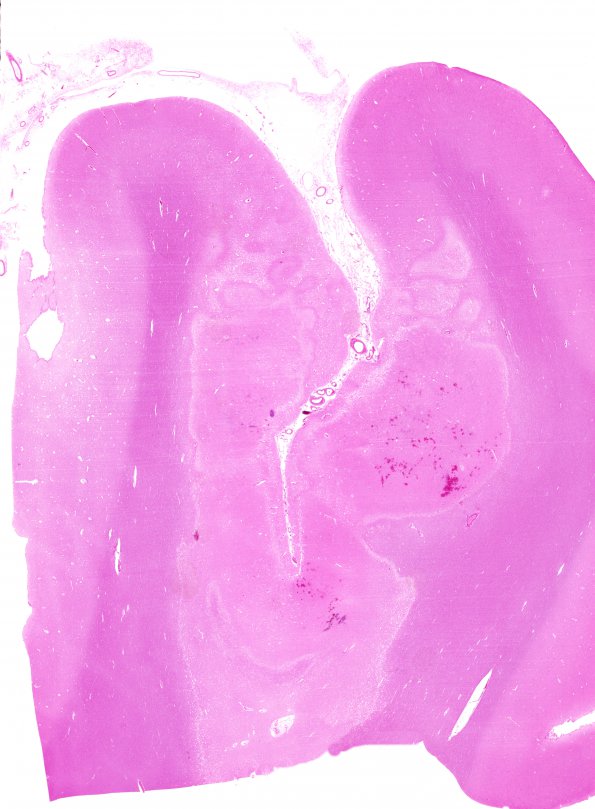 5B Infarct, watershed (Case 5) ACA-MCA