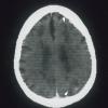 6A1 Infarct, Watershed (Case 6) CT