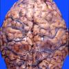 6B1 Infarct, Watershed (Case 6) 1 copy