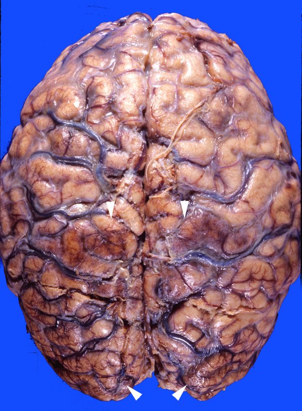 6B1 Infarct, Watershed (Case 6) 1 copy