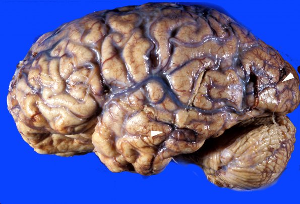 6B2 Infarct, Watershed (Case 6) c copy