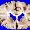 6B3 Infarct, watershed (Case 6) 8 copy