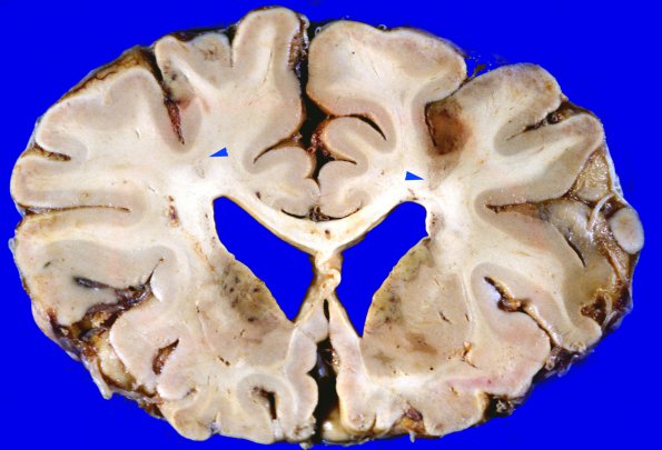 6B3 Infarct, watershed (Case 6) 8 copy