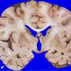 6B4 Infarct, watershed (Case 6) 6 copy