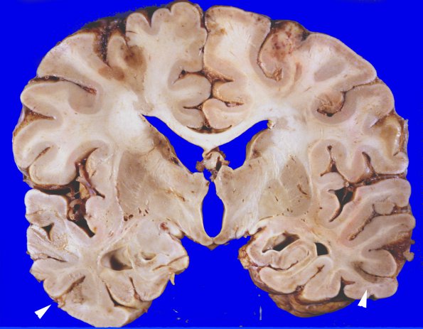 6B4 Infarct, watershed (Case 6) 6 copy