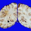 6B6 Infarct, watershed (Case 6) 10