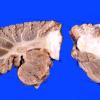 6B7 Infarct, Watershed (Case 6)