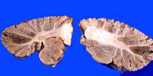 6B7 Infarct, Watershed (Case 6)