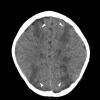 7A1 Infarct, watershed (Case 7) CT2