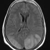 8A1 Infarcts, watershed (Case 8 TIRM 1 - Copy