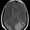 8A2 Infarcts, watershed (Case 8) T1 - Copy