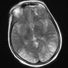 8A3 Infarct, watershed (Case 8) T2 TSE Blade 1 - Copy