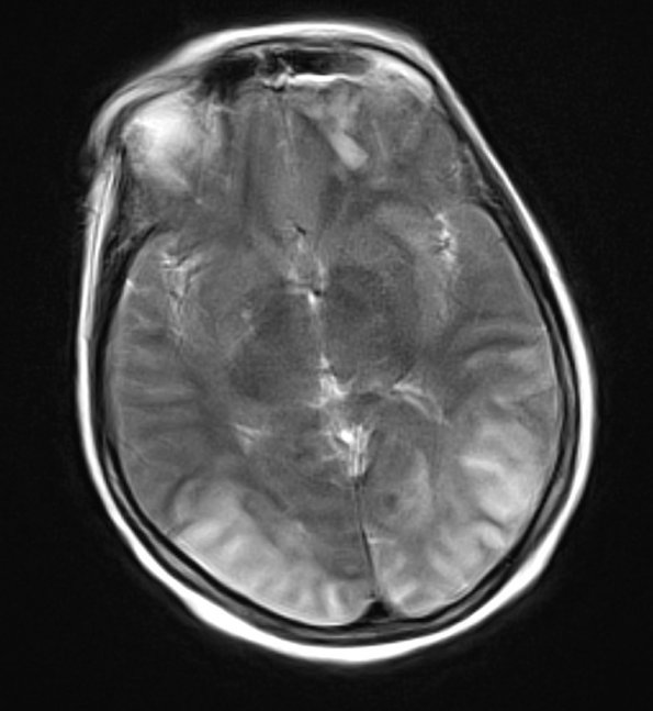 8A3 Infarct, watershed (Case 8) T2 TSE Blade 1 - Copy