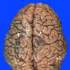 8B1 Infarct, watershed (Case 8)_1 copy