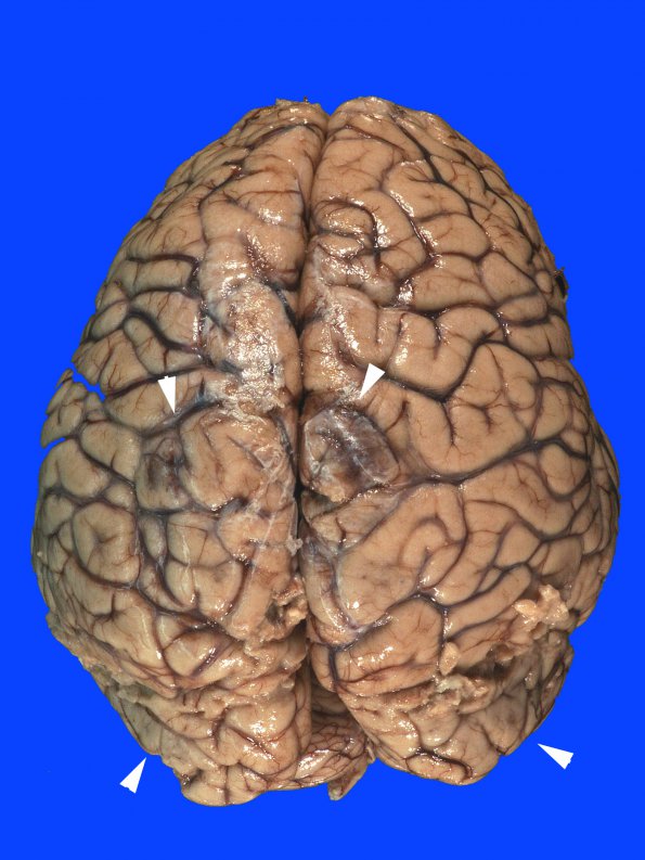 8B1 Infarct, watershed (Case 8)_1 copy