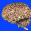 8B2 Infarct, watershed (Case 8)_2 copy