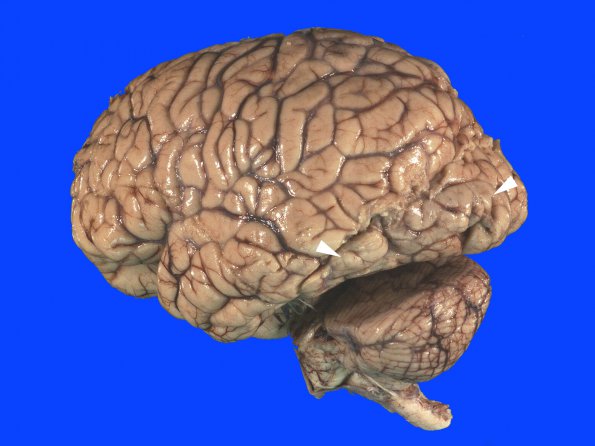 8B2 Infarct, watershed (Case 8)_2 copy