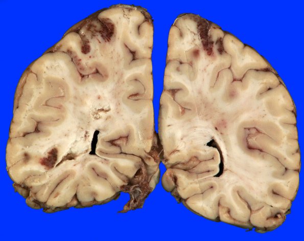 8B3 Infarcts, watershed with uncal herniation (Case 8) Gross _1