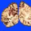 8B4 Infarct, watershed (Case 8)_5