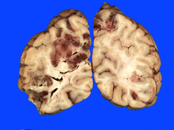 8B4 Infarct, watershed (Case 8)_5