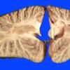 8B5 Infarct, watershed (Case 8)_6