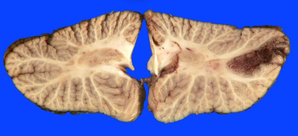 8B5 Infarct, watershed (Case 8)_6