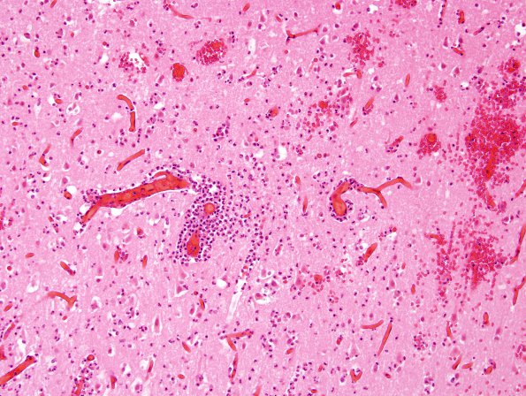 8C3 Infarcts, watershed (Case 8) H&E 3