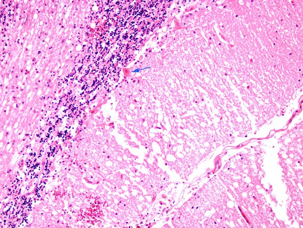 8C7 Infarcts, watershed (Case 8) H&E 16 copy