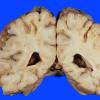 9A Infarct, watershed (Case 9A) 2