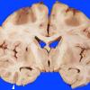 9B Infarct, Watershed one sided (Case 9B)