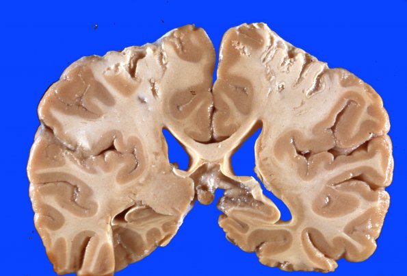 9C Infarct, Watershed, Sickle Cell Dz (Case 9C) a