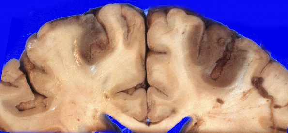 9D Infarcts, watershed (Case 9D)