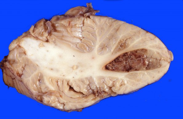 9E Infarct, watershed (watershed (Case 9E)) 1