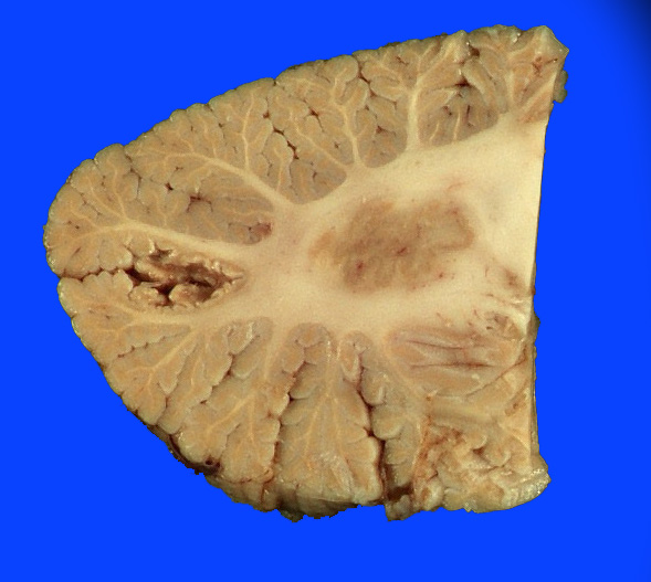 9F Infarct, watershed, horizontal fissure, remote (Case 9F)