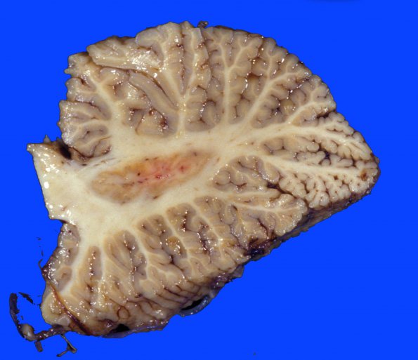 9G Infarct, Watershed (Case 9G)