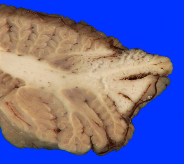 9H1 Infarction, remote (Case 9H) Gross _7