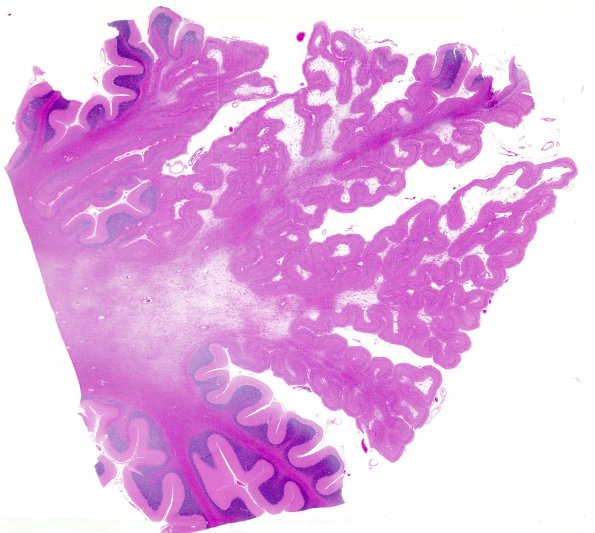 9H2 Hypoxia-Ischemia, cerebellum (Case 9H) WM