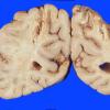 9I Infarct, watershed (Case 9I) 1