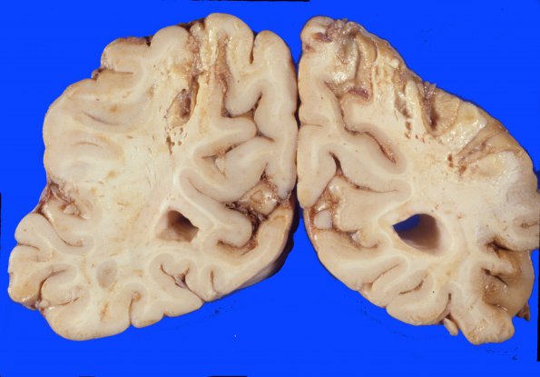 9I Infarct, watershed (Case 9I) 1