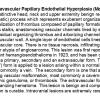 0A Intravascular Papillary Endothelial Hyperplasia - Text