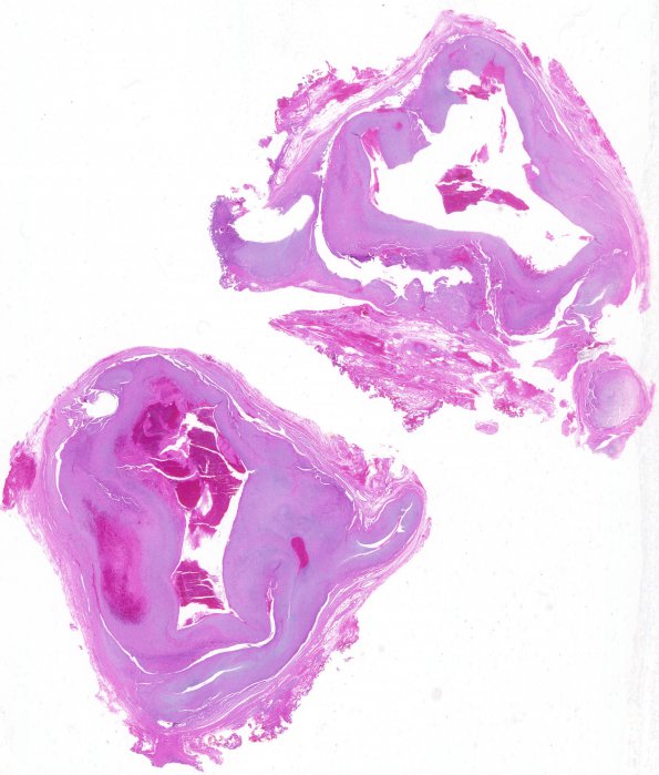 1A1 Intravascular Papillary Endothelial Hyperplasia (Case 1) 1 H&E WM