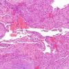 1A10 Intravascular Papillary Endothelial Hyperplasia (Case 1) H&E 20