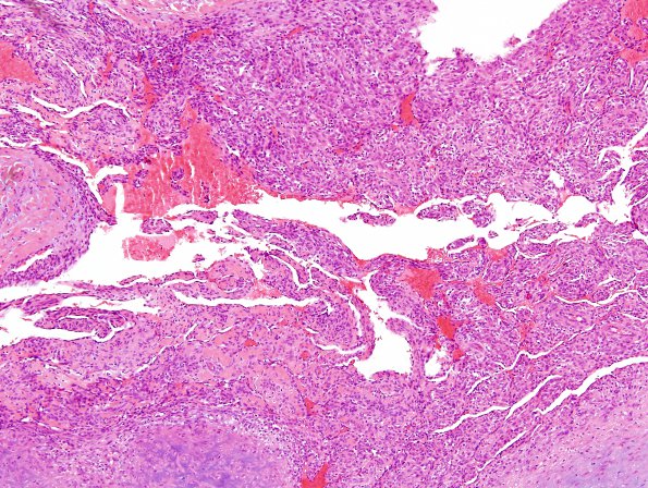 1A10 Intravascular Papillary Endothelial Hyperplasia (Case 1) H&E 20