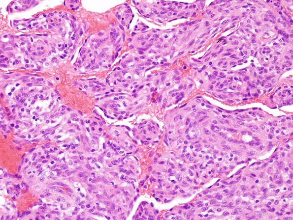 1A11 Intravascular Papillary Endothelial Hyperplasia (Case 1) H&E 22