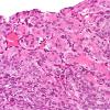 1A12 Intravascular Papillary Endothelial Hyperplasia (Case 1) H&E 1