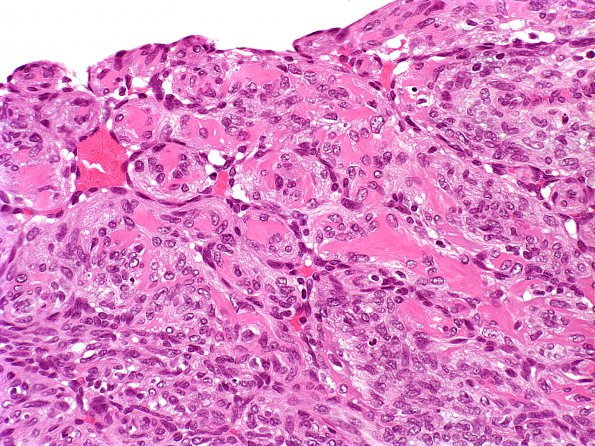 1A12 Intravascular Papillary Endothelial Hyperplasia (Case 1) H&E 1