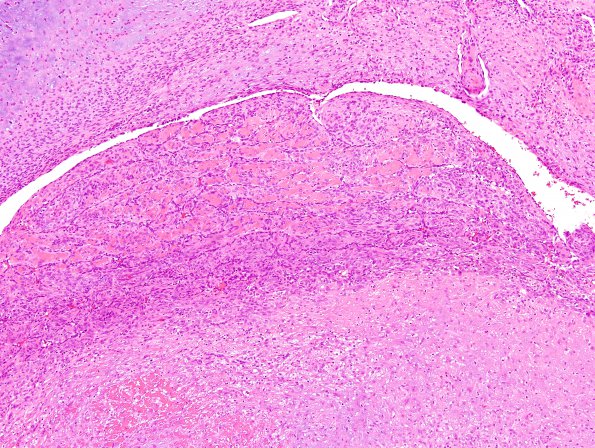 1A13 Intravascular Papillary Endothelial Hyperplasia (Case 1) H&E 21